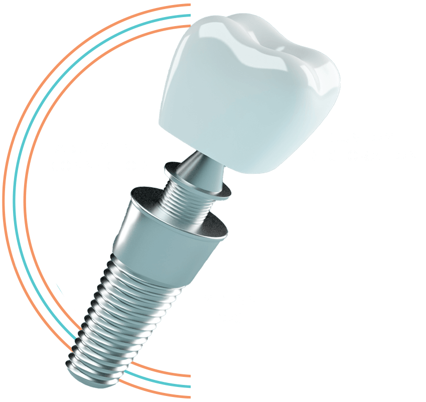 3 parts to dental implant