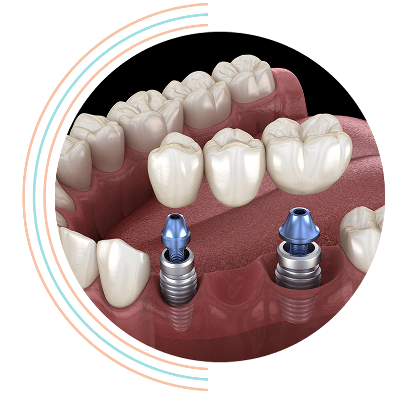 dental bridge 3d
