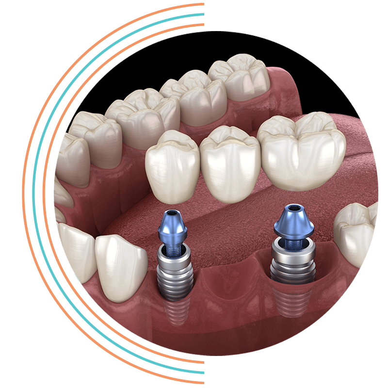 dental bridge implant