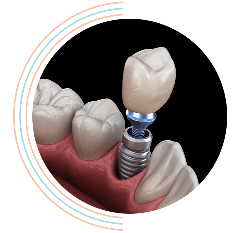 dental implant 3d
