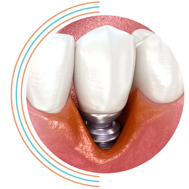 failing dental implants infection
