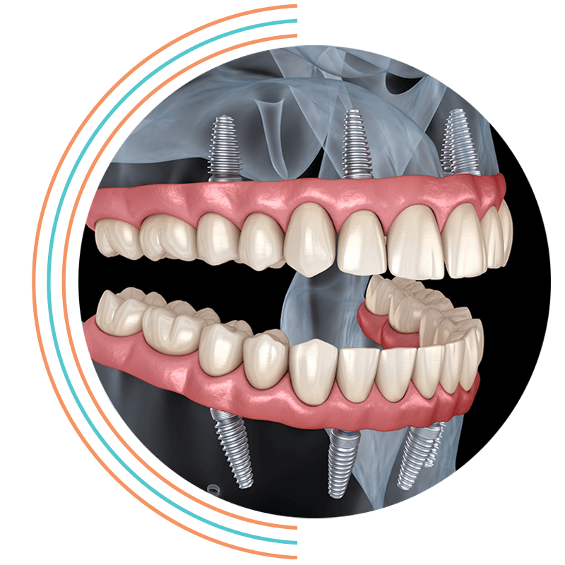 full arch dental implants all on 4