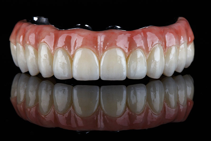 real full arch prothesis titanium