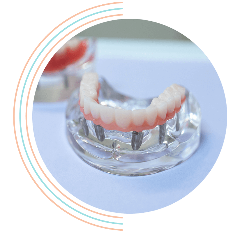 full arch barot real