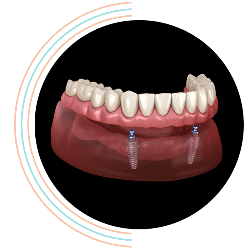 implant supported 3d