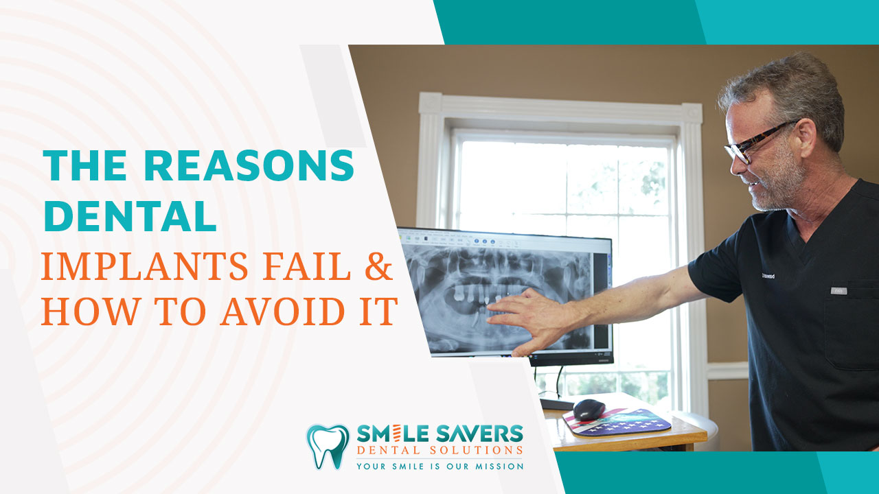 mv dental implants how they fail