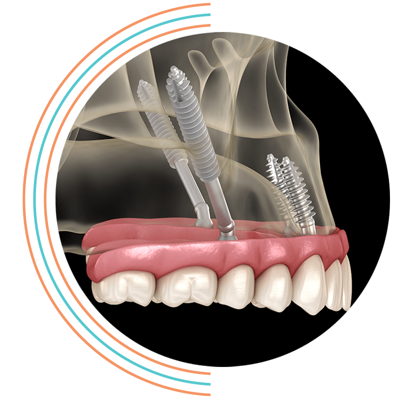 zygomatic dental implants